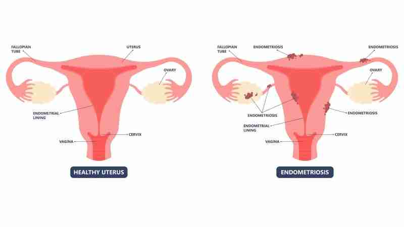 Appearance of endometriosis deposits on the reproductive organs