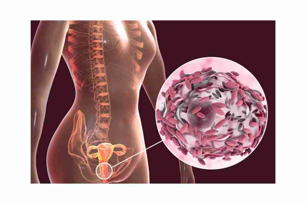 Graphic f the female anatomy with a small inset of germs that can cause abnormal vaginal discharge
