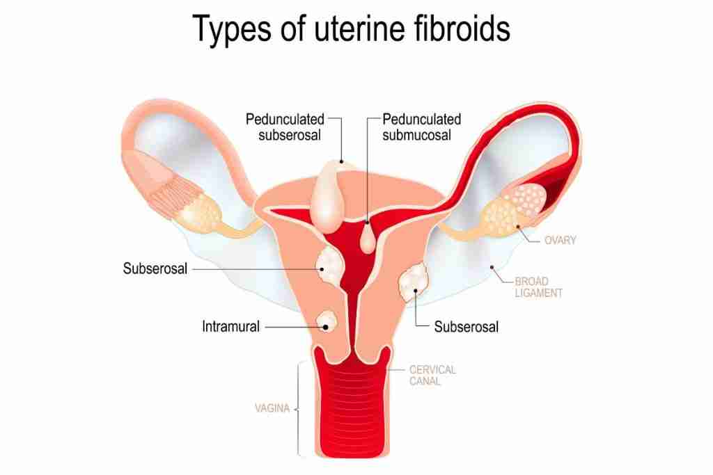 Image of the womb showing different types and locations of fibroids.