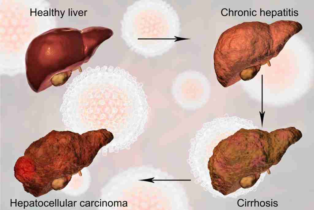 How the liver changes from healthy liver to liver cirrhosis