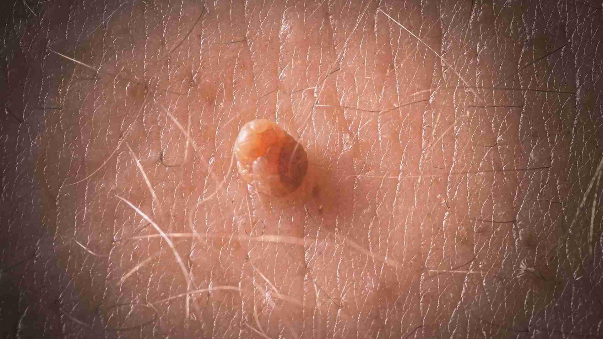 Genital Warts Treatment