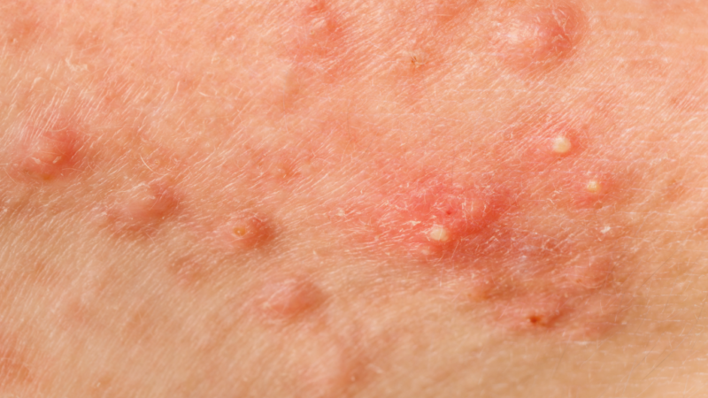 Abstract medical illustration of a skin lump representing a vaginal or vulval lump that should be checked by a doctor