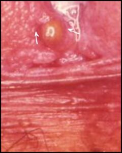 Type 3 Bartholin's cyst
