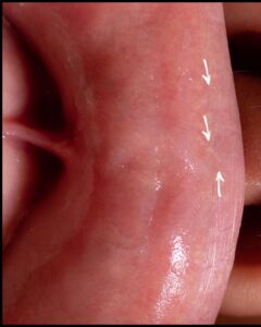 Type 2 Fordyce spots