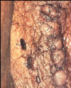 Type 5 genital warts