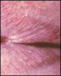 Type 6 Lichen sclerosus
