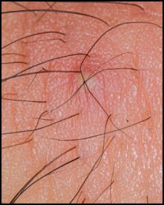 type 1 ingrown hair